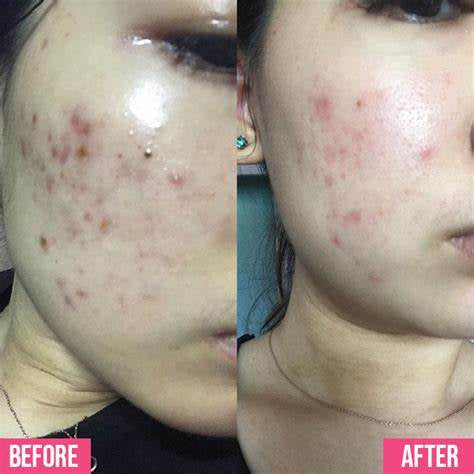 جل تنظيف لاروش بوزيه إيفاكلار (La Roche-Posay Effaclar Purifying Foaming Gel) بحجم 400 مل.