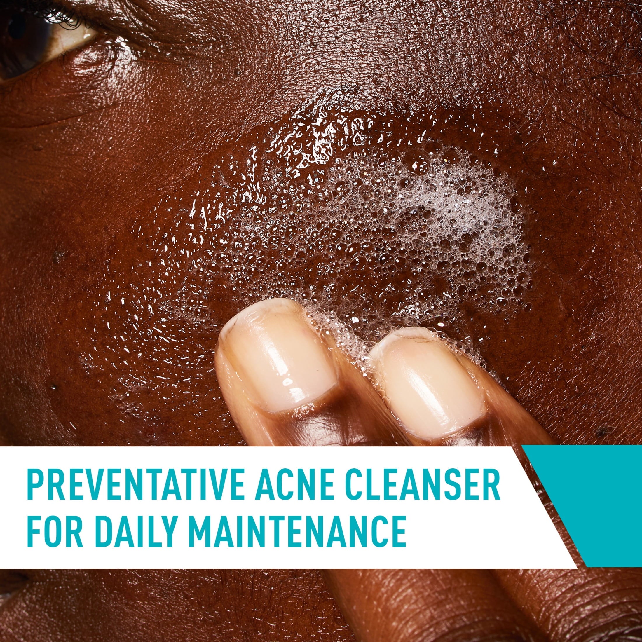 غسول سيرافي (CeraVe Acne Control Cleanser) بحجم 473 مل (Value Size)، وهو منتج مخصص للبشرة المعرضة لحب الشباب والدهنية