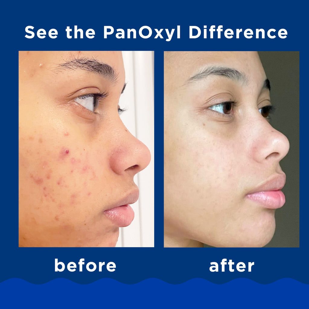 PanOxyl Acne Foaming Wash Benzoyl Peroxide 10% Max Strength - 156g | بانوكسيل غسول رغوي لحب الشباب البنزويل بيروكسايد 10% - 156 غرام